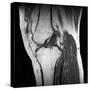 Anterior Cruciate Ligament Tear, CT Scan-Du Cane Medical-Stretched Canvas