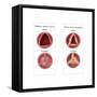 Aortic Valve Comparison-Monica Schroeder-Framed Stretched Canvas