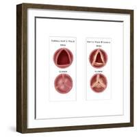 Aortic Valve Comparison-Monica Schroeder-Framed Art Print