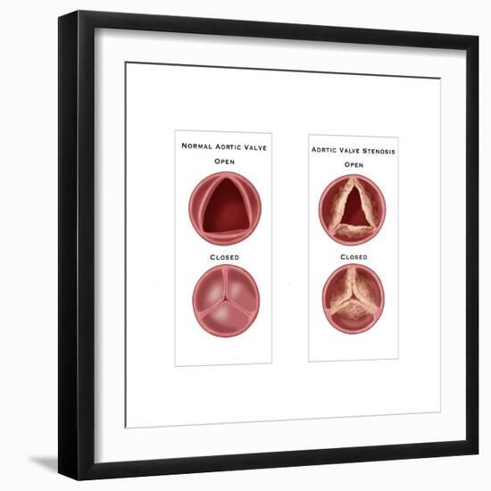 Aortic Valve Comparison-Monica Schroeder-Framed Art Print