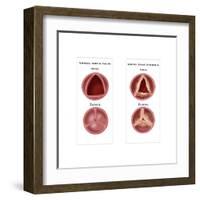 Aortic Valve Comparison-Monica Schroeder-Framed Art Print