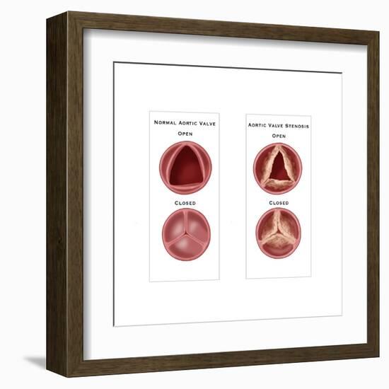 Aortic Valve Comparison-Monica Schroeder-Framed Art Print