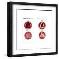 Aortic Valve Comparison-Monica Schroeder-Framed Art Print