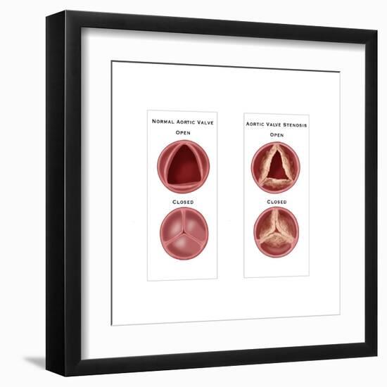 Aortic Valve Comparison-Monica Schroeder-Framed Art Print