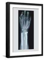 Arm and Finger Repair-null-Framed Art Print