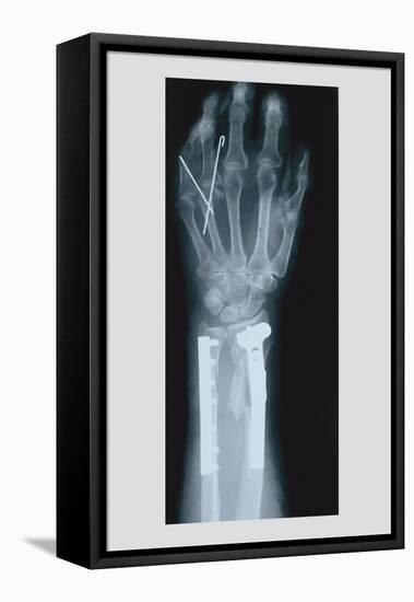 Arm and Finger Repair-null-Framed Stretched Canvas