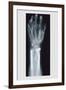 Arm and Finger Repair-null-Framed Art Print