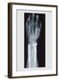 Arm and Finger Repair-null-Framed Art Print