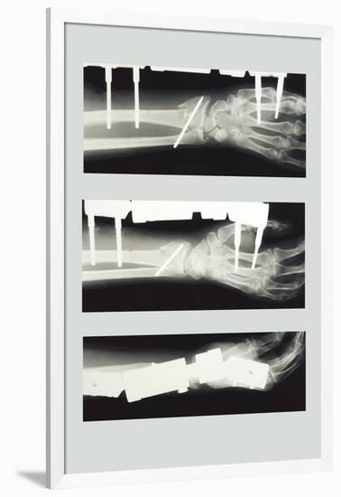 Arm with External Fixation-null-Framed Art Print