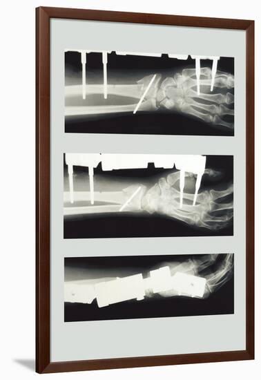 Arm with External Fixation-null-Framed Art Print