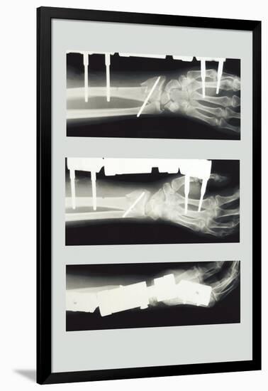 Arm with External Fixation-null-Framed Art Print