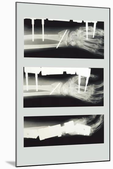 Arm with External Fixation-null-Mounted Art Print