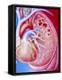 Art of Pulmonary Tuberculosis with Lung Cavities-John Bavosi-Framed Stretched Canvas