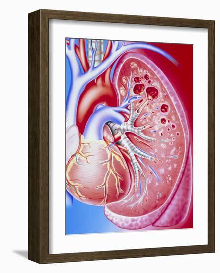 Art of Pulmonary Tuberculosis with Lung Cavities-John Bavosi-Framed Photographic Print