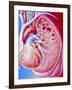 Art of Pulmonary Tuberculosis with Lung Cavities-John Bavosi-Framed Photographic Print