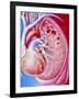 Art of Pulmonary Tuberculosis with Lung Cavities-John Bavosi-Framed Photographic Print