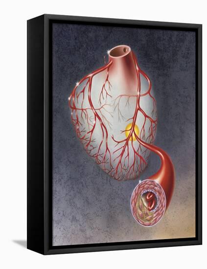 Arteries on Heart Showing Atherosclerotic Plaque in an Artery-null-Framed Stretched Canvas