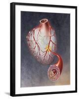 Arteries on Heart Showing Atherosclerotic Plaque in an Artery-null-Framed Art Print