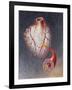 Arteries on Heart Showing Atherosclerotic Plaque in an Artery-null-Framed Art Print