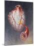 Arteries on Heart Showing Atherosclerotic Plaque in an Artery-null-Mounted Art Print