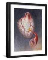 Arteries on Heart Showing Atherosclerotic Plaque in an Artery-null-Framed Art Print