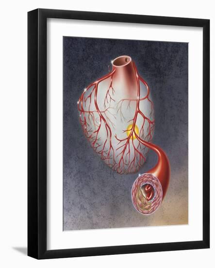 Arteries on Heart Showing Atherosclerotic Plaque in an Artery-null-Framed Art Print