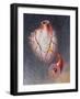 Arteries on Heart Showing Atherosclerotic Plaque in an Artery-null-Framed Art Print