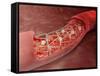 Artery Cross-section with Blood Flow And Stent Deployment-Stocktrek Images-Framed Stretched Canvas