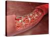 Artery Cross-section with Blood Flow And Stent Deployment-Stocktrek Images-Stretched Canvas