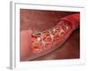 Artery Cross-section with Blood Flow And Stent Deployment-Stocktrek Images-Framed Photographic Print