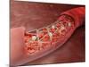 Artery Cross-section with Blood Flow And Stent Deployment-Stocktrek Images-Mounted Photographic Print