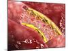 Artery Cross-Section with Blood Flow, Fat Plaque and Stent Deployment-null-Mounted Art Print