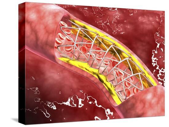 Stretched Canvas Print, , large