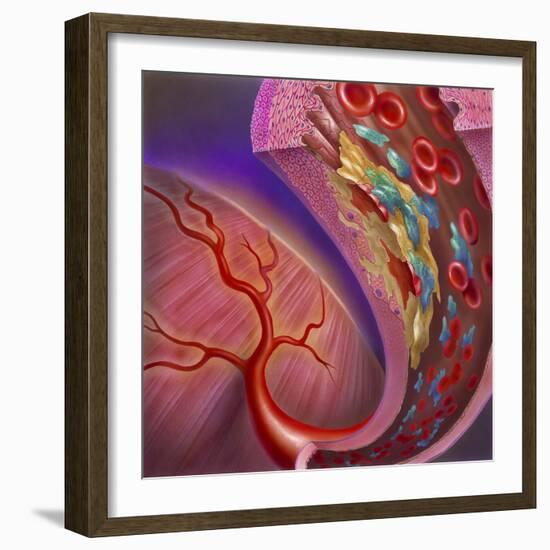 Artery Showing Atherosclerotic Plaque, Platelets and Red Blood Cells-null-Framed Art Print