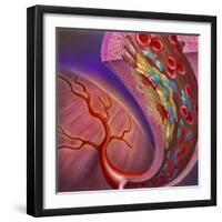 Artery Showing Atherosclerotic Plaque, Platelets and Red Blood Cells-null-Framed Art Print