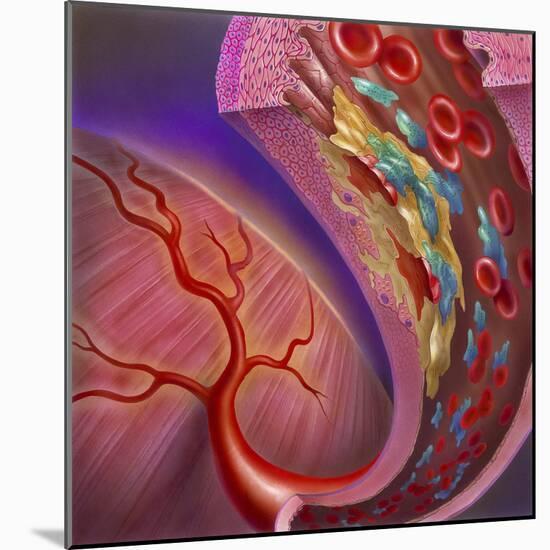 Artery Showing Atherosclerotic Plaque, Platelets and Red Blood Cells-null-Mounted Art Print