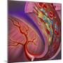 Artery Showing Atherosclerotic Plaque, Platelets and Red Blood Cells-null-Mounted Art Print