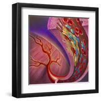 Artery Showing Atherosclerotic Plaque, Platelets and Red Blood Cells-null-Framed Art Print