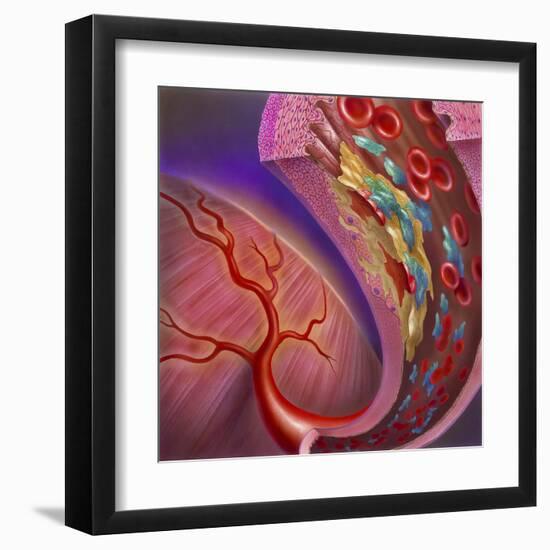 Artery Showing Atherosclerotic Plaque, Platelets and Red Blood Cells-null-Framed Art Print