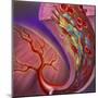 Artery Showing Atherosclerotic Plaque, Platelets and Red Blood Cells-null-Mounted Art Print