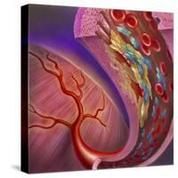 Artery Showing Atherosclerotic Plaque, Platelets and Red Blood Cells-null-Stretched Canvas