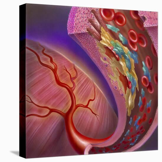 Artery Showing Atherosclerotic Plaque, Platelets and Red Blood Cells-null-Stretched Canvas