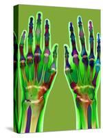 Arthritic Hands, X-ray-Du Cane Medical-Stretched Canvas