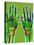 Arthritic Hands, X-ray-Du Cane Medical-Stretched Canvas