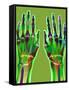 Arthritic Hands, X-ray-Du Cane Medical-Framed Stretched Canvas