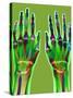 Arthritic Hands, X-ray-Du Cane Medical-Stretched Canvas