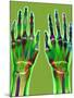 Arthritic Hands, X-ray-Du Cane Medical-Mounted Premium Photographic Print