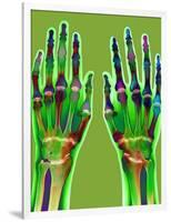 Arthritic Hands, X-ray-Du Cane Medical-Framed Photographic Print