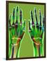 Arthritic Hands, X-ray-Du Cane Medical-Framed Photographic Print