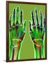 Arthritic Hands, X-ray-Du Cane Medical-Framed Photographic Print